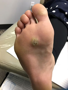 plantar warts treatment in the Bahamas, New Providence: Nassau (Golden Gates Estates, Palmdale, Downtown Nassau, Little Hermitage, Elizabeth Estates, Greater Chippingham, Jubilee Subdivision, Palm Cay, Carmichael Village, Adelaide, Adelaide Village, Highbury Park, Kensington Garden) areas